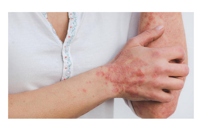 CBD en psoriasis: hoe effectief is het?
